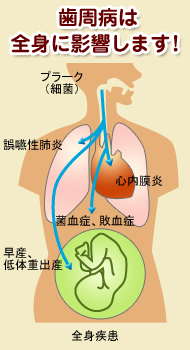 歯周病は全身に影響します!